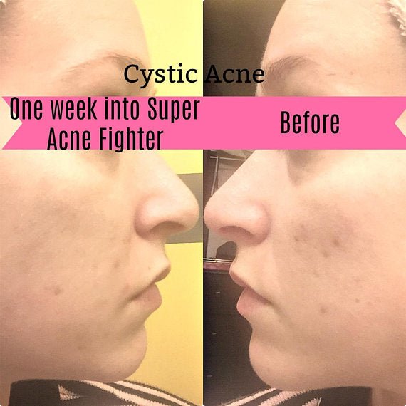 Super Acne Fighter / Organic Acne Treatment / Acne - AllYearGoods