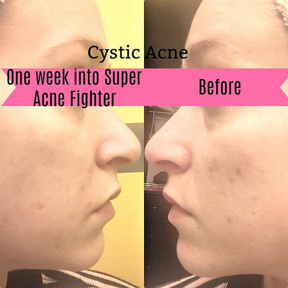 Super Acne Fighter / Organic Acne Treatment / Acne - AllYearGoods